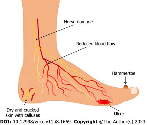 Understanding the multifaceted etiopathogenesis of foot complications ...
