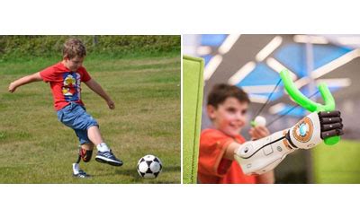 Pediatric Mobility Innovations from KARE Prosthetics and Orthotics Services