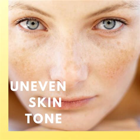 Uneven Skin tone Treatment - Beauty Grace