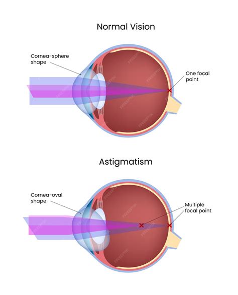 Normal vision vs astigmatism eye anatomy and light refraction | Premium Vector