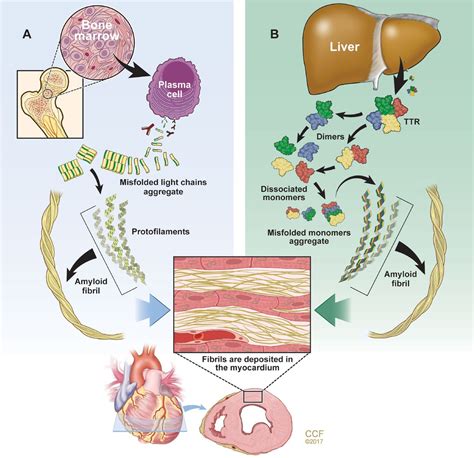 Cardiac amyloidosis: An update on diagnosis and treatment | Cleveland ...