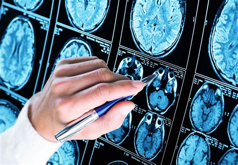 Donanemab-azbt Demonstrated Long-Term Efficacy in Slowing Cognitive Decline