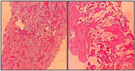 Grey Zones in Breast Cytology: Diagnostic Challenges