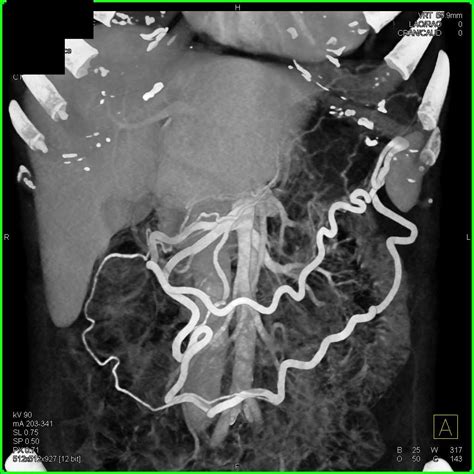 Adenocarcinoma Pancreas - Pancreas Radiology Case Studies - CTisus CT ...
