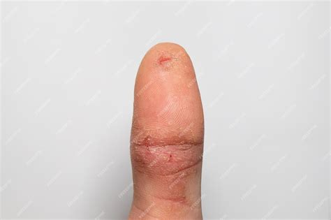 Premium Photo | Damaged finger skin cracks and peels wound on a mans finger due to a ...