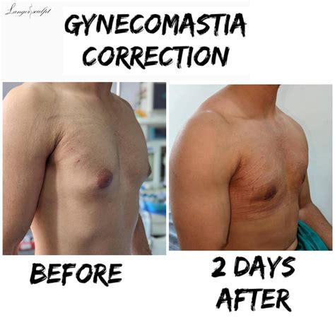 Chest Fat After Gynecomastia Surgery at Pauline Dane blog