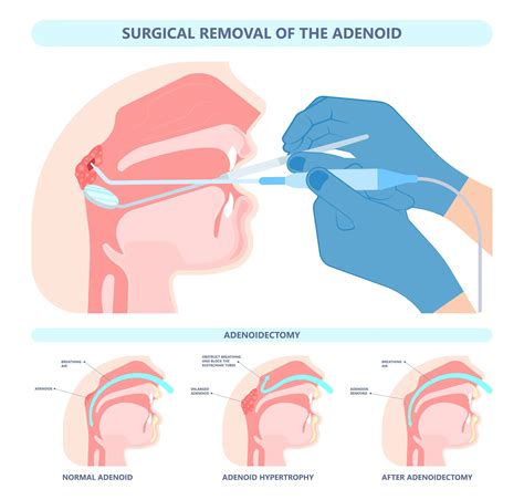 Adenoidectomy: The Pros And Cons Of Removing Adenoids | Credihealth - ideal age for adenoid removal