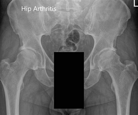 Hip xrays normal - factoryfeti