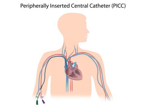 Picc Line Diagram : Access Lumen Triple Central Intravenous Devices Venous Short | Boiboiwasuoi ...