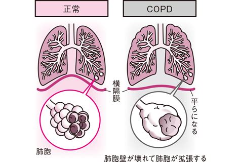呼吸困難に関するQ＆A | 看護roo![カンゴルー]