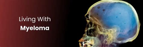 Living with Myeloma: Strategies and Support