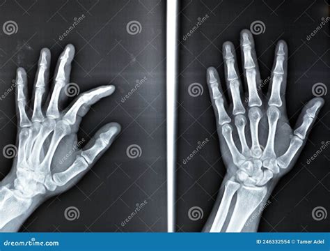 Avulsion Fracture Healing Time Finger at Michael Dalrymple blog