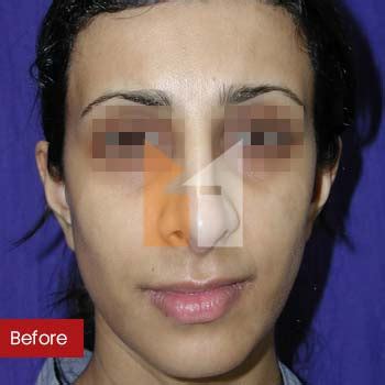 Jaw (Cheekbone) Implants, Facial Implants (Augmentation) Surgery in ...