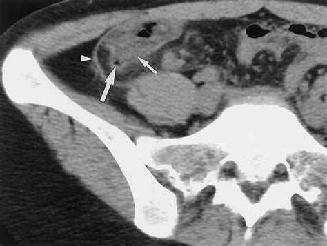 Disproportionate Fat Stranding: A Helpful CT Sign in Patients with ...