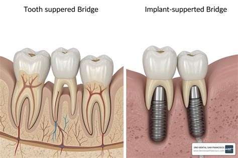 Full Mouth Bridge