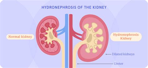 Hydronephrosis: Causes, Symptoms, and Treatment | Fluent Health