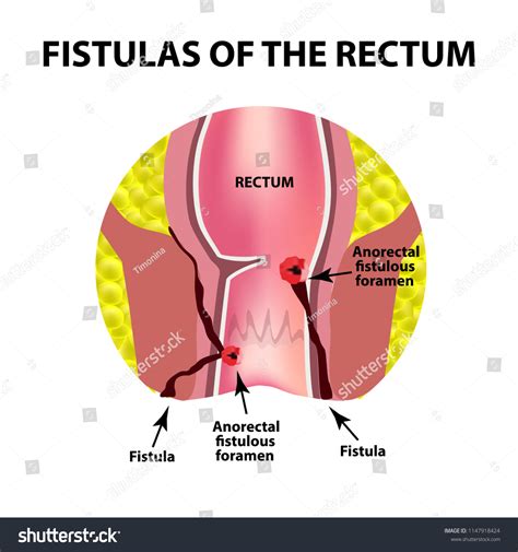 Types Fistulas Rectum Paraproctitis Anus Abscess: illustrazione stock ...