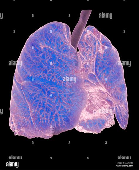 Scarred lungs. Digitally enhanced 3D computed tomography (CT) scan of scarring on human lungs ...