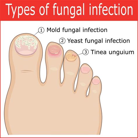 Fungal Infection On Foot Fingers Treatment Clearance | emergencydentistry.com