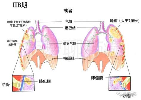 肺癌分几种类型？ - 知乎