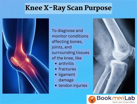 Knee X-Ray: Purpose, Results, Risks, Preparation & Price