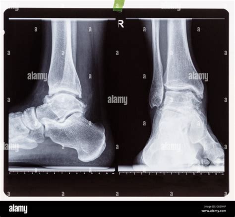 Ankle X Ray Anatomy Labeled at Henry Trethowan blog