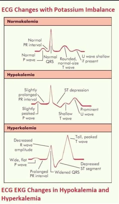 Sine Wave Hyperkalemia Ecg Changes