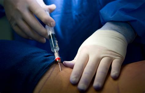 Use of Local anesthesia in postoperative phase reduces chance of delirium