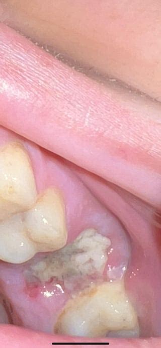 Image result for Infected Tooth Extraction Aftercare