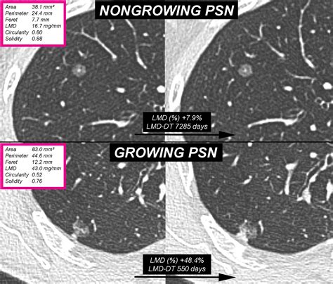 Quantitative CT Analysis for Predicting the Behavior of Part-Solid ...