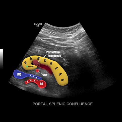 Portal Vein Anatomy Ultrasound