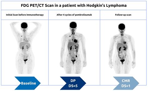 Pet Scan Lymphoma