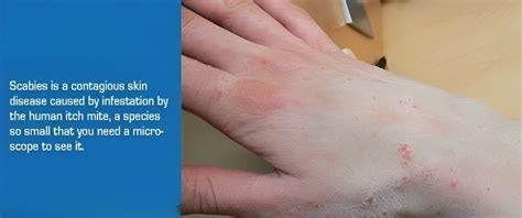 Scabies Outbreak in Malawi UPSC