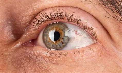 FDA approves ENCELTO, first-of-its-kind eye implant that slows vision ...