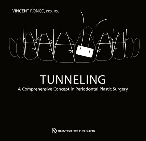 Vincent Ronco | Tunneling | Quintessenz Verlags-GmbH