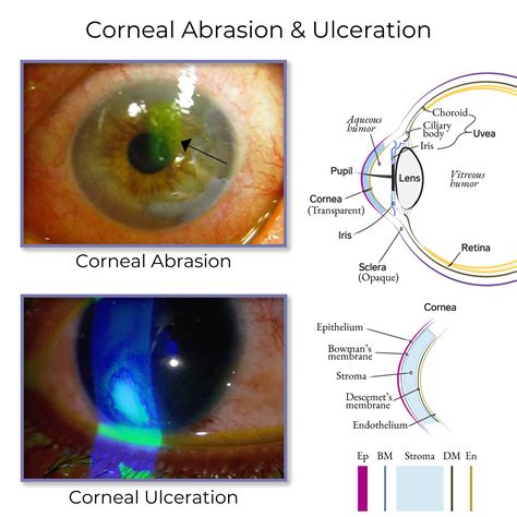 Corneal Abrasion Vs Ulcer