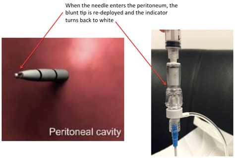 Image result for Paracentesis Procedure Kit
