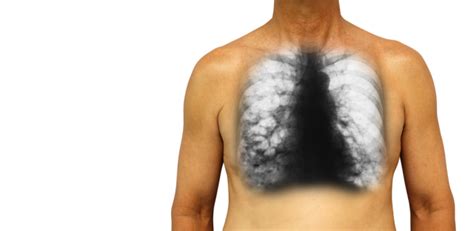 ब्रोन्किइक्टेसिस (Bronchiectasis) के बारे में पाएं पूरी जानकारी - हैलो ...