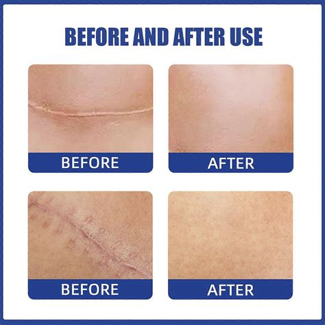 Silicone Scar Sheets Silicone Scar Sheets For Breast 4 Pairs Breast Reduction After Surgery For ...