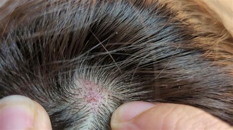 Scalp Rash Management at Rita Clark blog