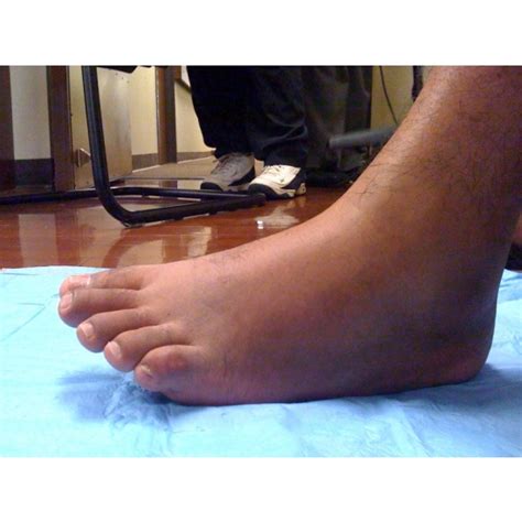 Excruciating Left Ankle Pain