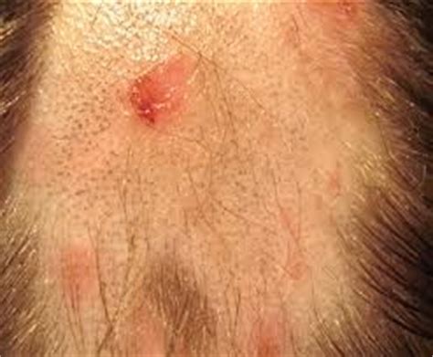 Shingles on scalp: Pictures, symptoms and treatment for Shingles on scalp | Tips Curing Disease