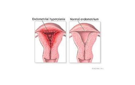 Image result for Hyperplastic Endometrium