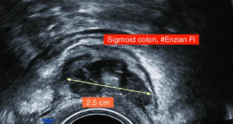 Image result for Colonoscopy Sigma Loop