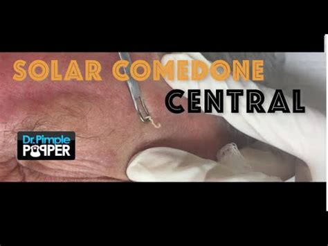 Image result for Solar Comedones Extraction