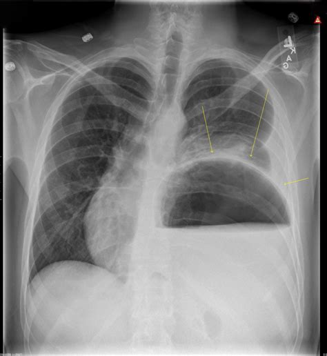 Sharp Pain In Chest Gas Bubble at Lucy Sutcliffe blog