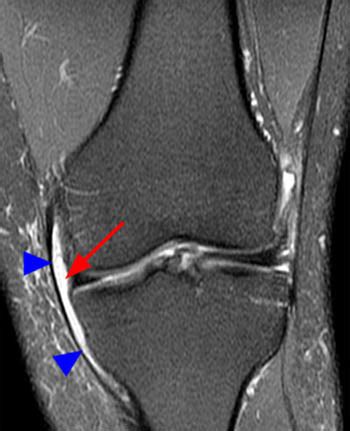 Kuvatulokset haulle pes anserine bursitis