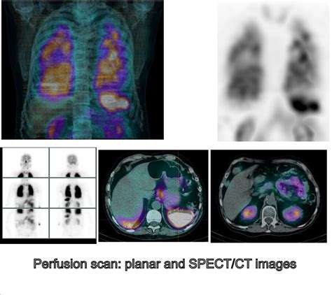 Nuclear Medicine Lung Perfusion Scan Nuclear Scans: MedlinePlus