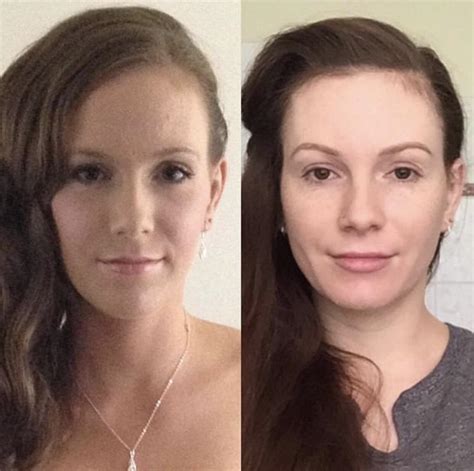 Image result for Tooth Extraction Side Profile