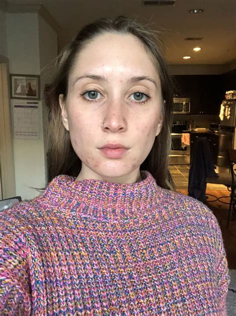 I'm so frustrated with my skin. It's gotten to the point where it hurts to wash my face ...